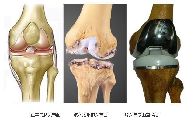 骨关节炎可以彻底治愈吗