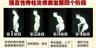 强直性脊柱炎
