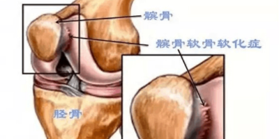 髌骨软化症是怎么回事？髌骨软化症有什么治疗方法？