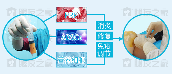 SVF治疗半月板损伤