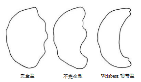 盘状半月板分型