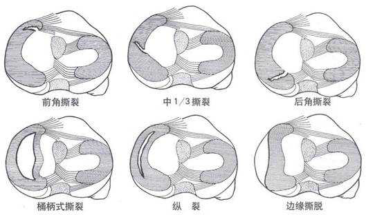 半月板损伤