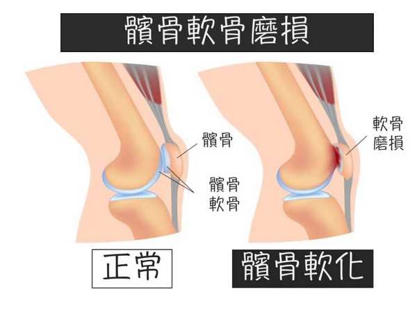 髌骨关节炎