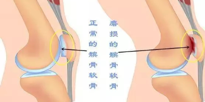 髌骨软化有什么好的治疗方法？能自愈吗？