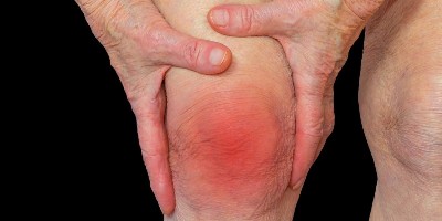 rheumatoid-arthritis-knee
