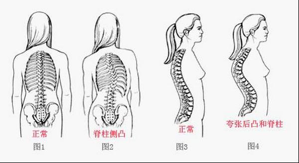 先天性脊柱侧弯
