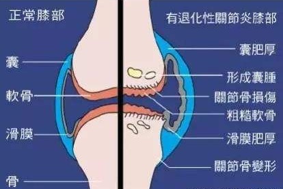 退行性关节炎怎么办