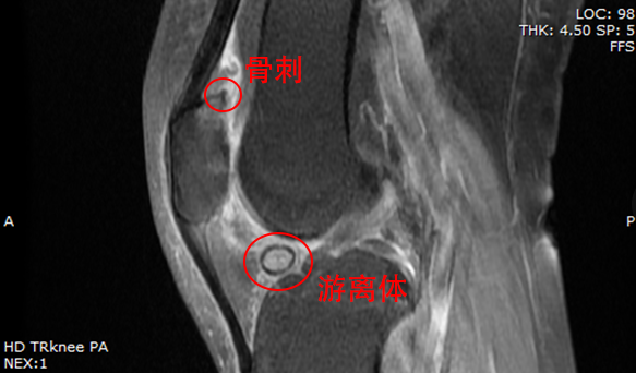 骨质增生和游离体