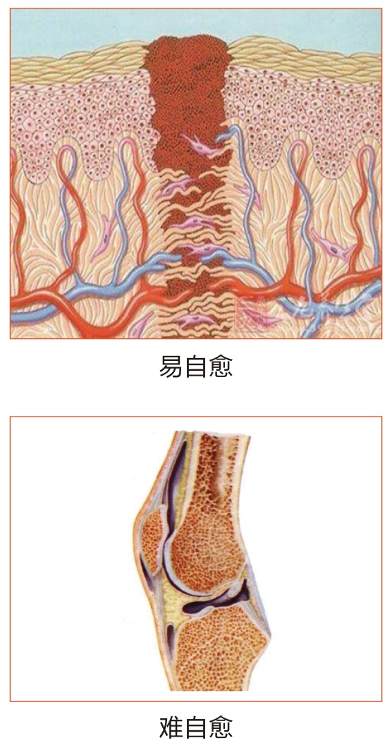 膝关节软骨损伤难自愈