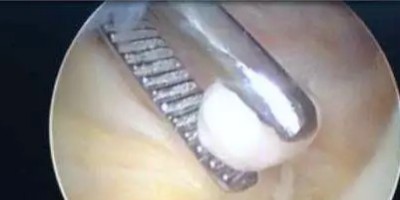 游离体关节鼠是怎么回事？腿友之家告诉你