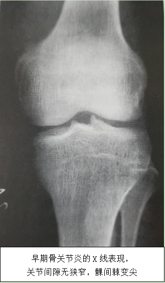 骨性关节炎X线片