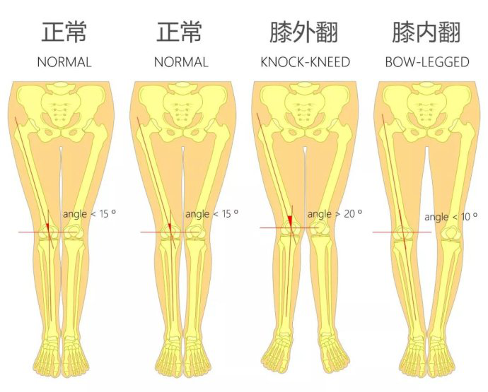 膝外翻膝内翻