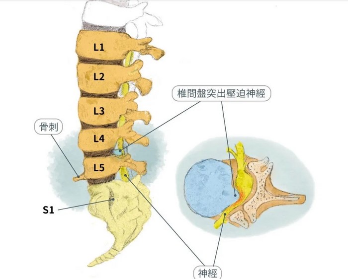 关节炎坐骨神经痛