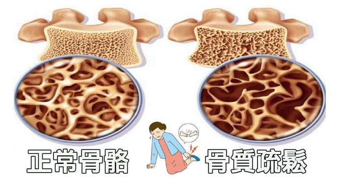 关节炎骨质疏松