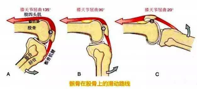 髌骨软化症