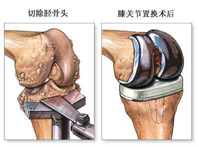 人工膝关节置换