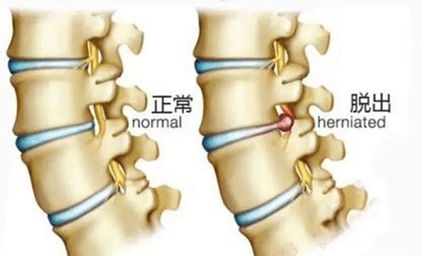 腰椎间盘突出