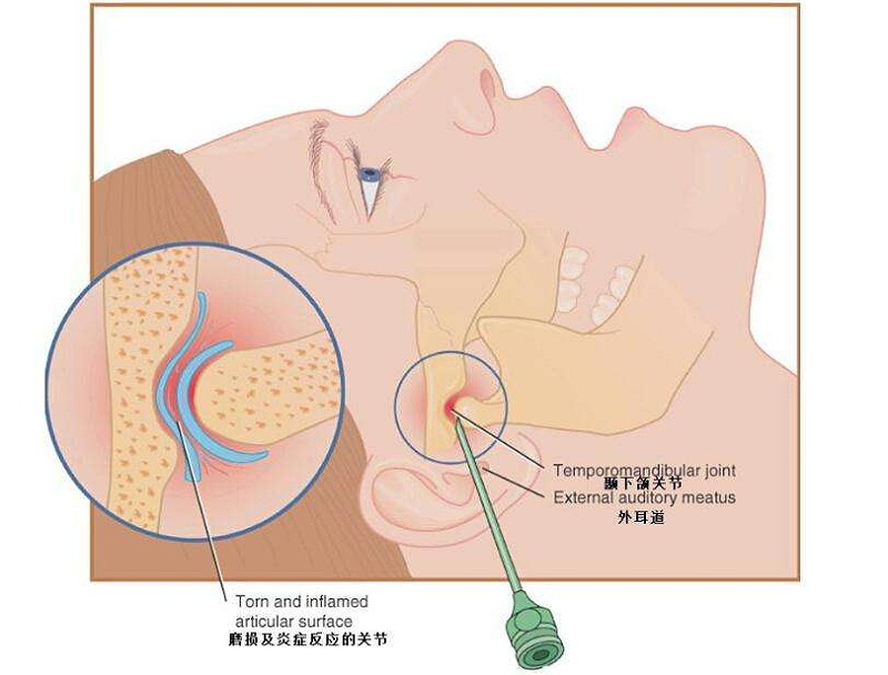 颞颌关节炎