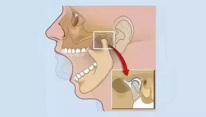 颞颌关节炎