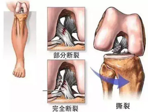 膝关节韧带撕裂类型