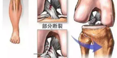 膝关节韧带撕裂分为哪几类？
