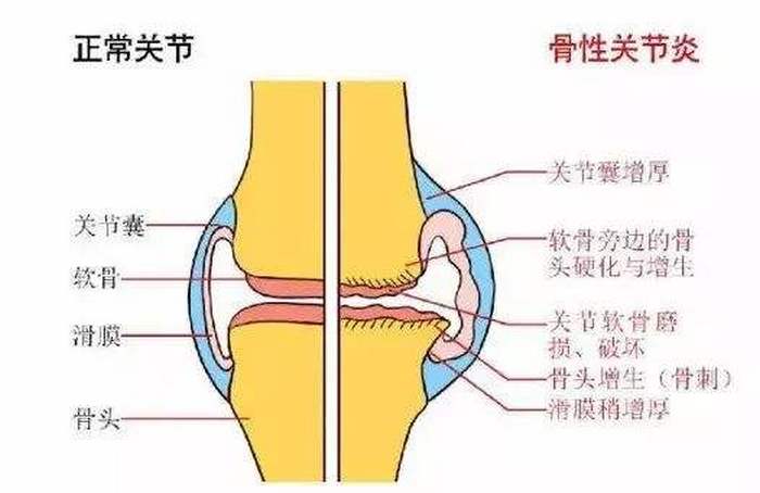 退化性关节炎