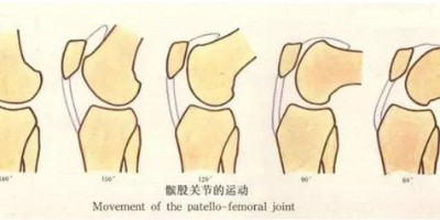 髌骨是哪个位置？髌骨软化症严重吗？