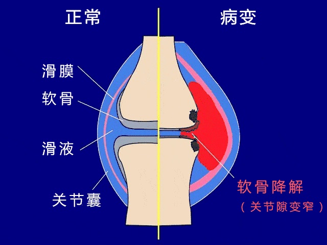 滑膜炎怎么治疗最有效