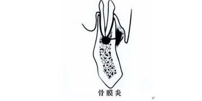 腿有骨膜炎关节炎