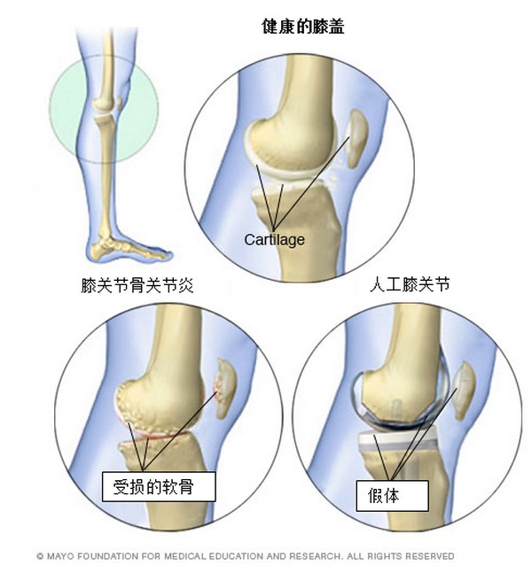 骨关节炎的治疗办法