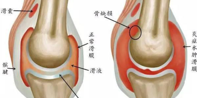 膝关节类风湿关节炎