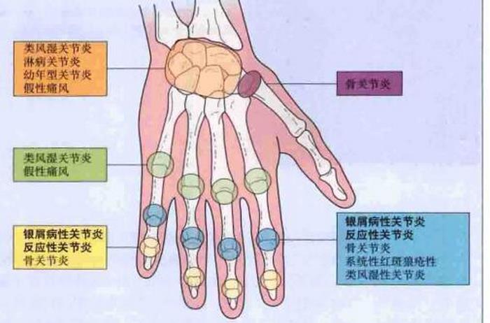 银屑病性关节炎