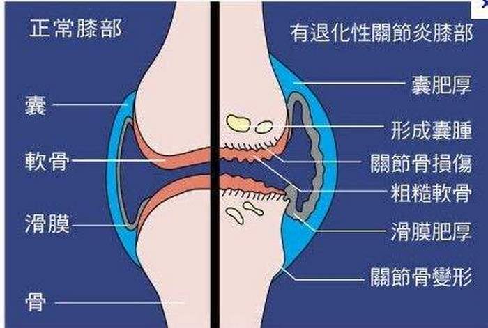 退化性关节炎