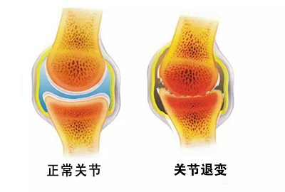 关节退变