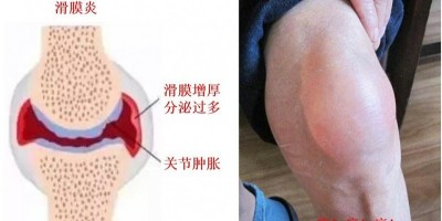 滑膜炎为什么反复发作老不好？怎么治疗滑膜炎