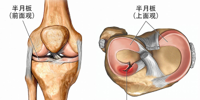 半月板损伤怎么治疗好？半月板撕裂分型？