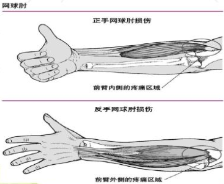 网球肘病理