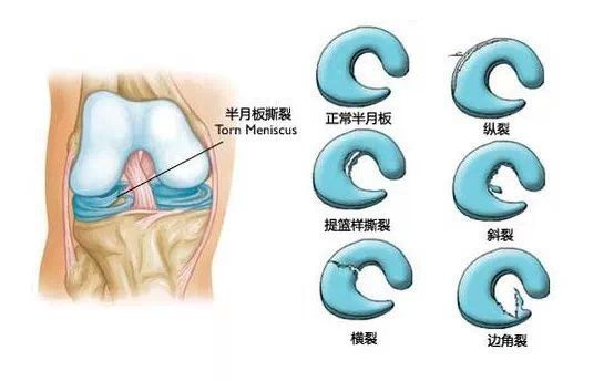 半月板撕裂分型