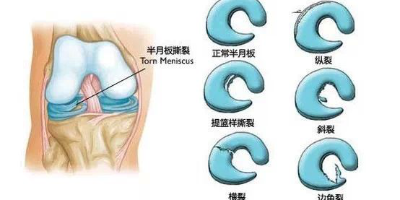 半月板撕裂有哪些症状？分几种类型？