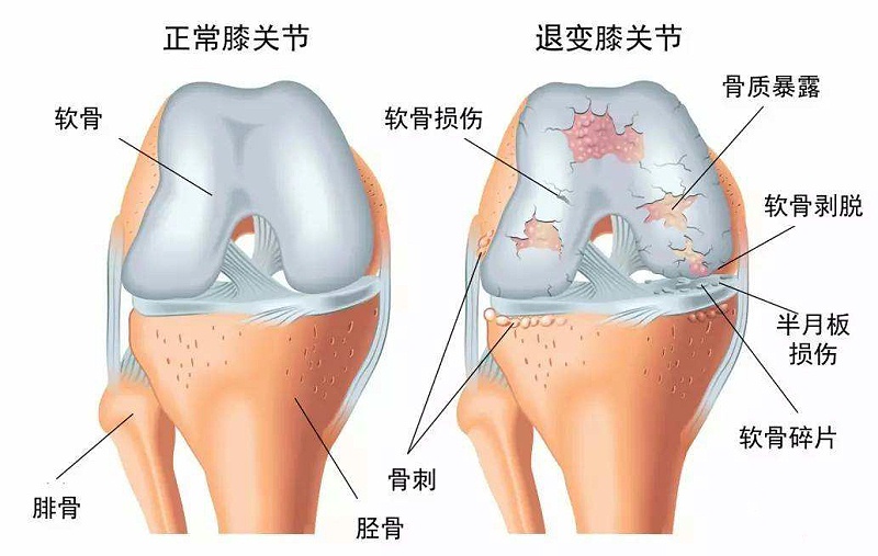 骨关节炎