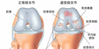 骨关节炎