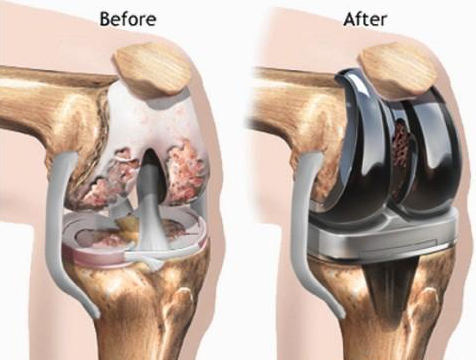 膝关节置换