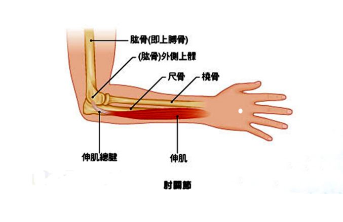 网球肘肱骨外上髁炎