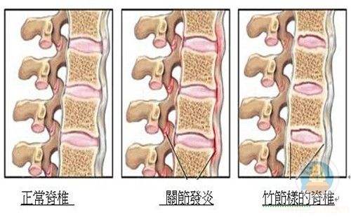 强直性脊柱炎