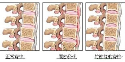 脊椎炎