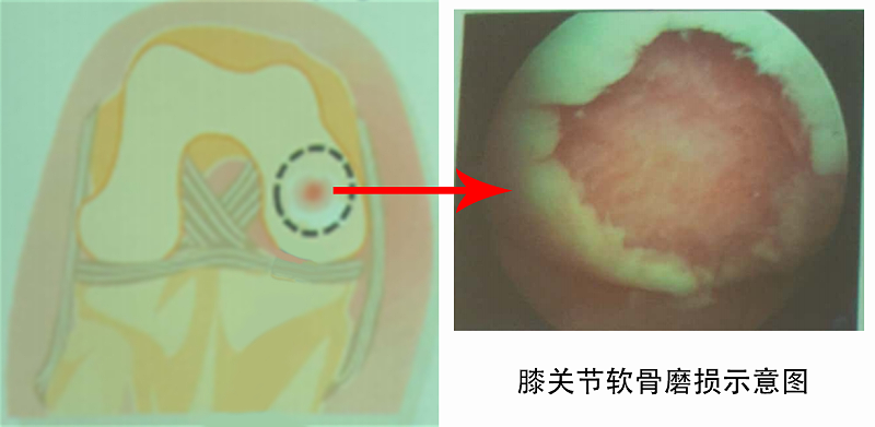 膝关节软骨磨损