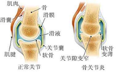 骨性关节炎关节退变