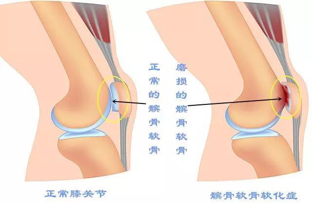 骨关节炎