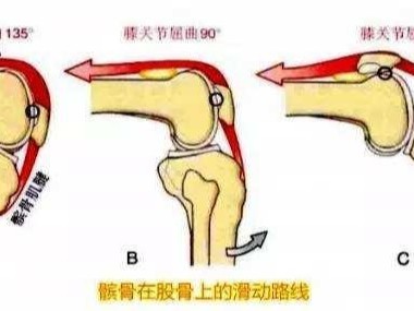 什么是髌骨软化症？腿友之家告诉你