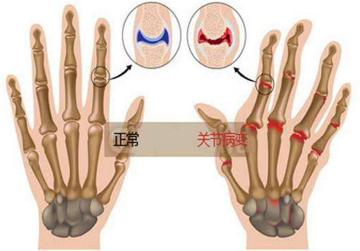 类风湿关节炎